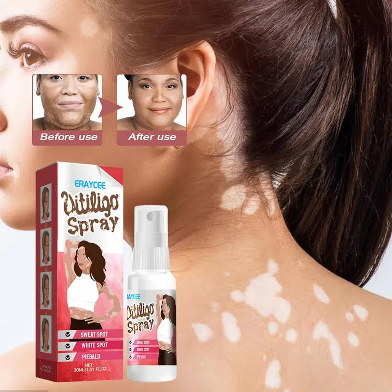 Vitiligo Relief Spray - Image 7