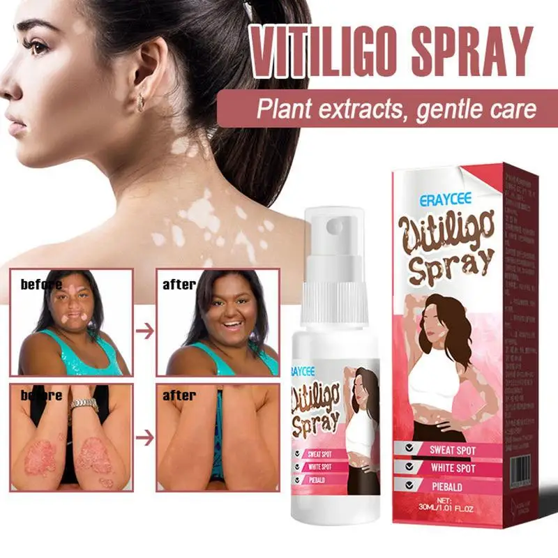 Vitiligo Relief Spray - Image 5