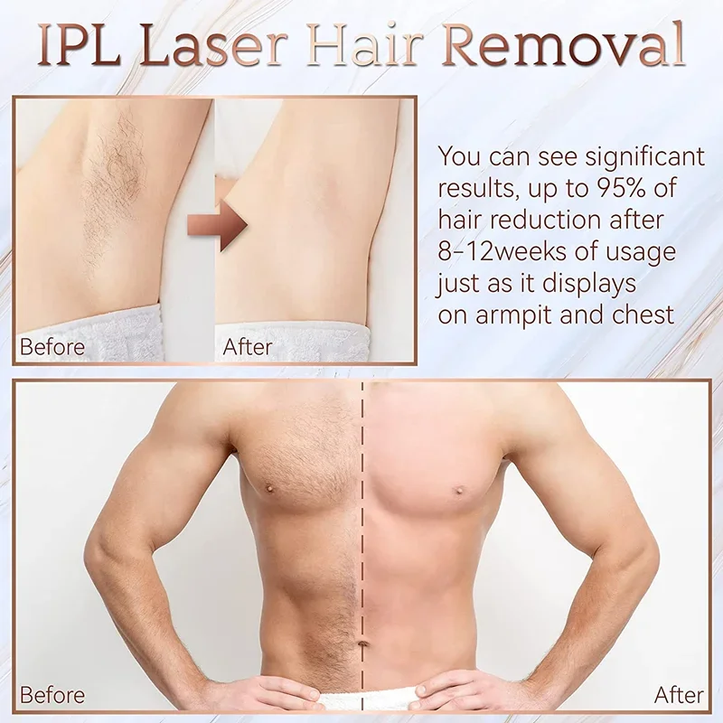 Non Laser Hair Removal - Image 10