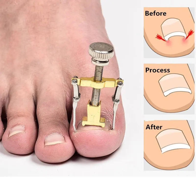 Toenail Screw - Image 7