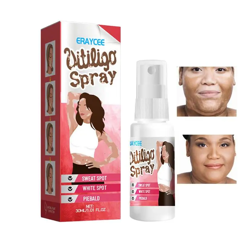 Vitiligo Relief Spray - Image 3