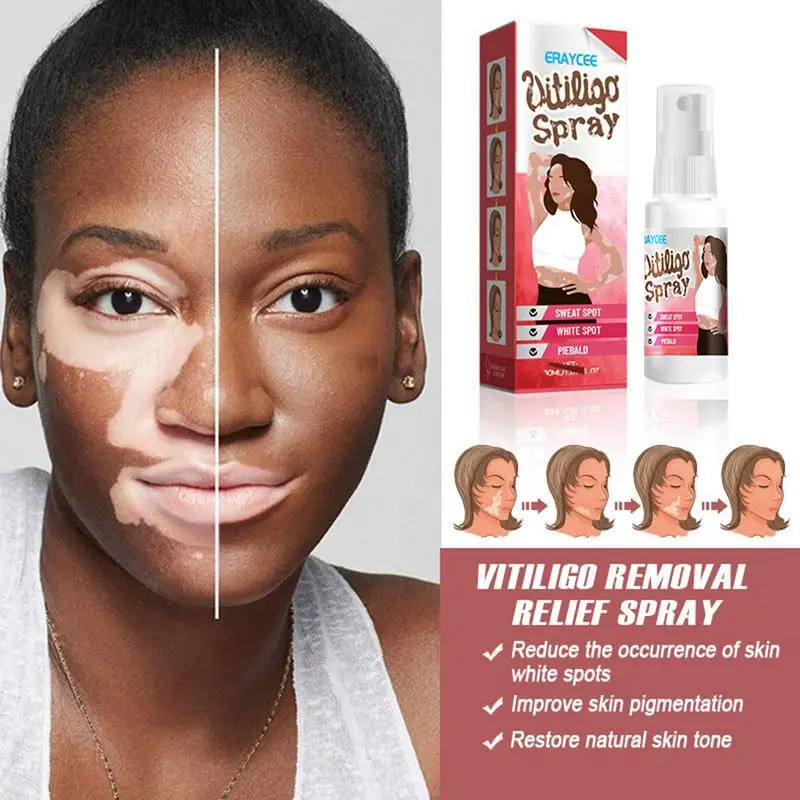 Vitiligo Relief Spray - Image 4